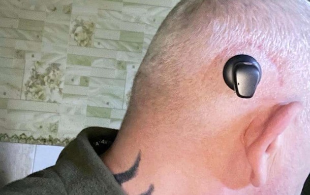 Львовские врачи вживили военному слуховой аппарат в череп