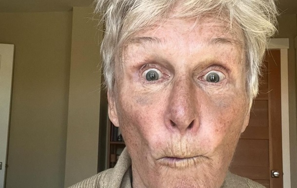 Актриса Гленн Клоуз напередодні свого 77-річчя зламала носа