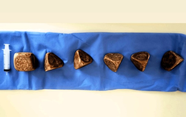 У сечовому міхурі чоловіка знайшли 2 кг каменів