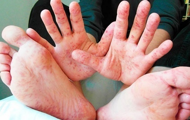 В Киеве растет заболеваемость корью