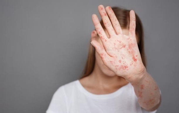 В Україні зафіксували до 1,2 тис. випадків кору з початку року