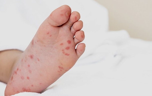 Вспышка вируса Коксаки на Киевщине: заболели 13 детей