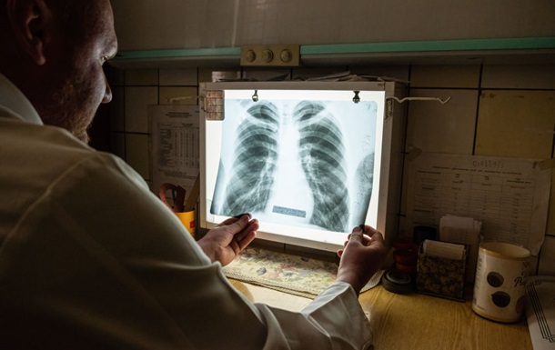 В Украине появляются случаи внелегочного туберкулеза - ЦГЗ