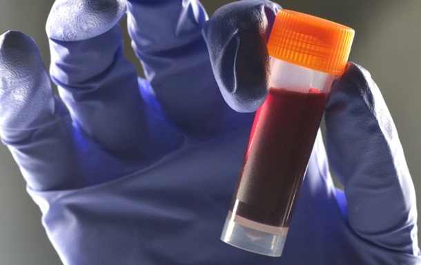 Вчені виявили зв’язок між групою крові та ризиком діабету 2 типу
